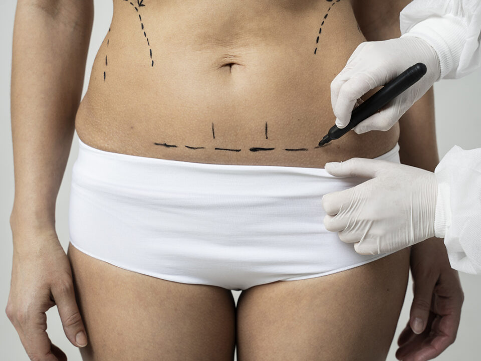 El Ci en cirugía estética